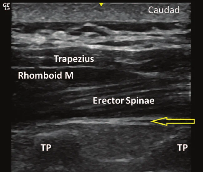Ultrasound image of erector spinae plane block showing trapezius, rhomboid, erector spinae, and transverse processes