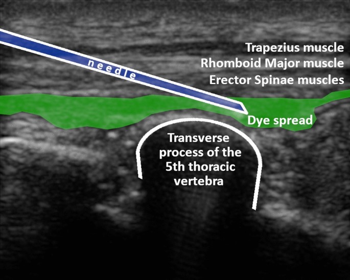 Annotated ultrasound showing needle in erector spinae plane with dye spread at the transverse process of T5