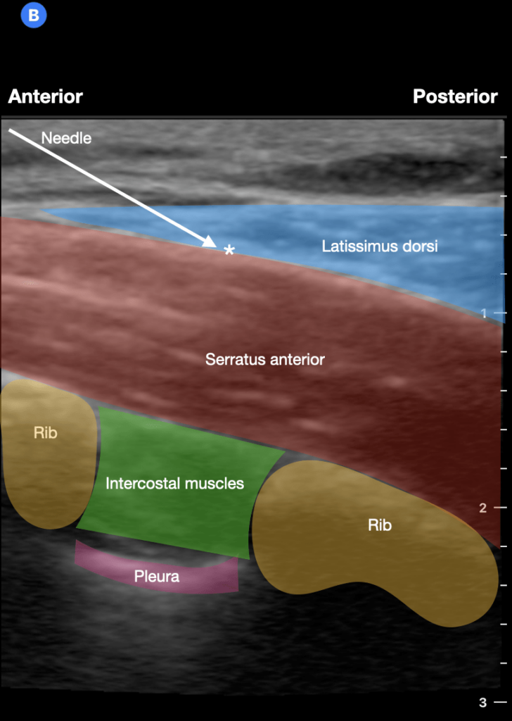 Ultrasound image of serratus anterior plane block showing needle, latissimus dorsi, serratus anterior, rib, and pleura