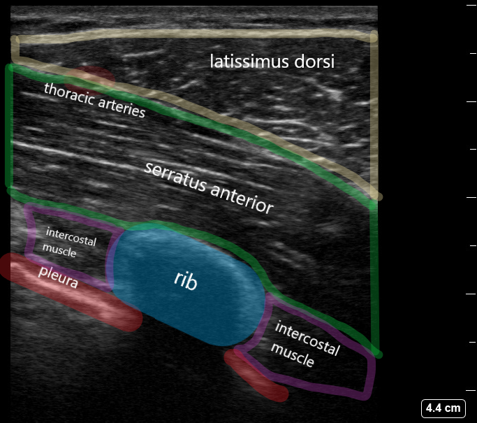 Annotated ultrasound of serratus anterior block showing latissimus dorsi, serratus anterior, rib, intercostal muscle, and pleura